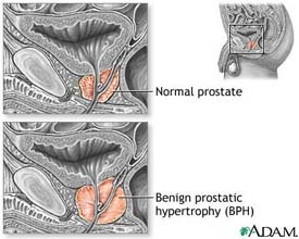 Benign Prostatic Hyperplasia
